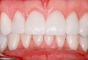 Cossich Family Dentistry | Teeth Whitening, Invisalign reg  and Periodontal Treatment